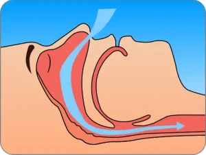 睡眠時無呼吸症候群